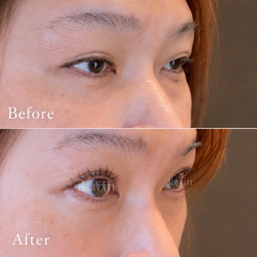 「目が開きにくく、眠そうに見える」|「他店で思ったように上がらなかった」|「年齢とともにまぶたが重く感じる」|そんなお悩みにも。